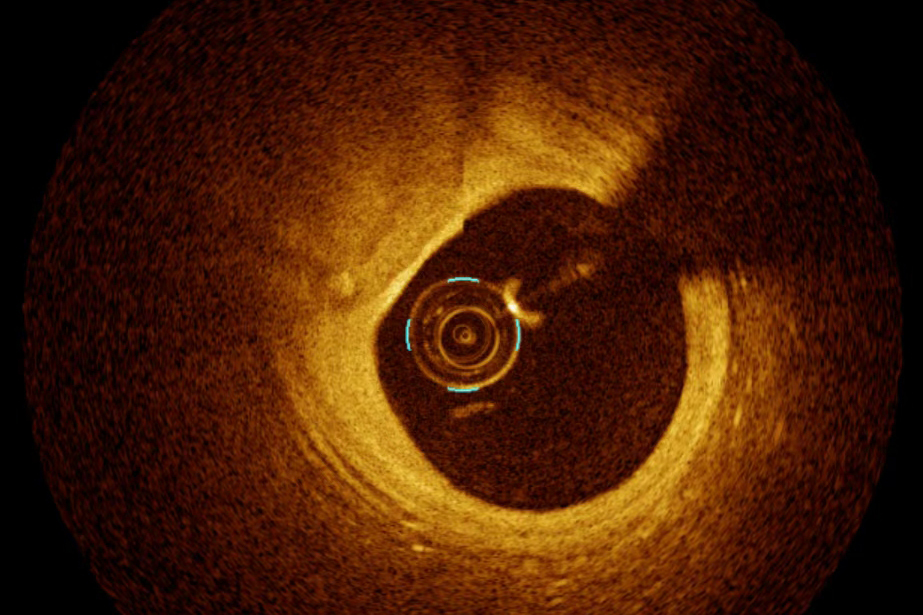 经验手感+设备护航“双保险”，桂林的冠脉介入也可以这么精准
