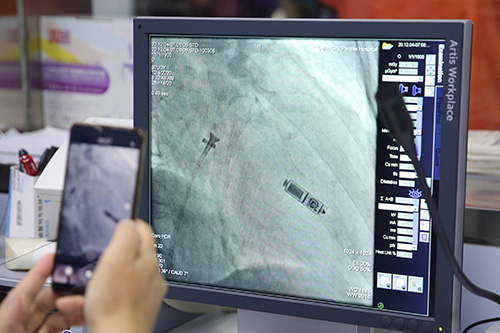 重仅1.7克，可续航12年，桂林人医植入桂北首个无导线心脏起搏器
