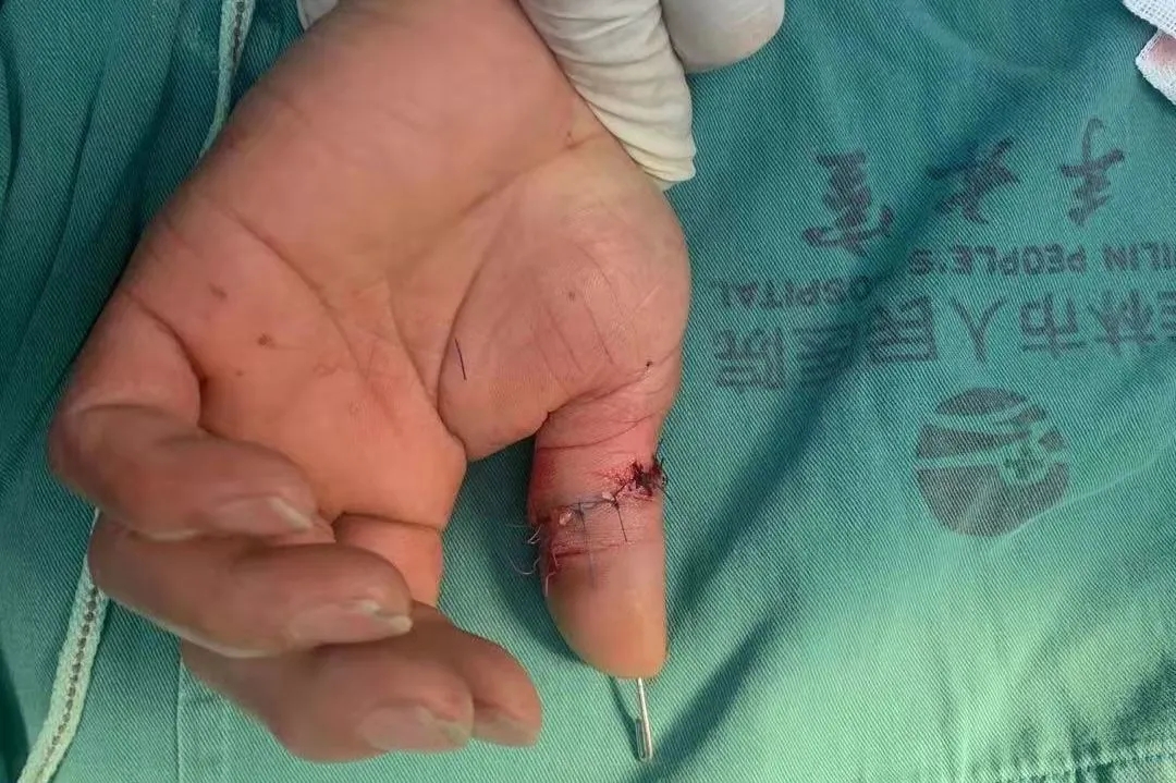 在花式接完二十余例断指后，医生提示，桂林干这类活得小心了