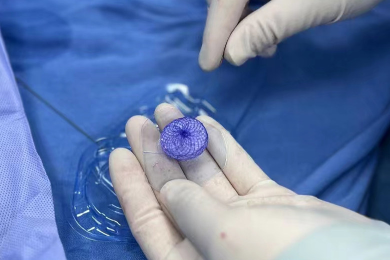 因多了个“心眼”女子头痛二十余年，医生用“消失的它”神奇封堵