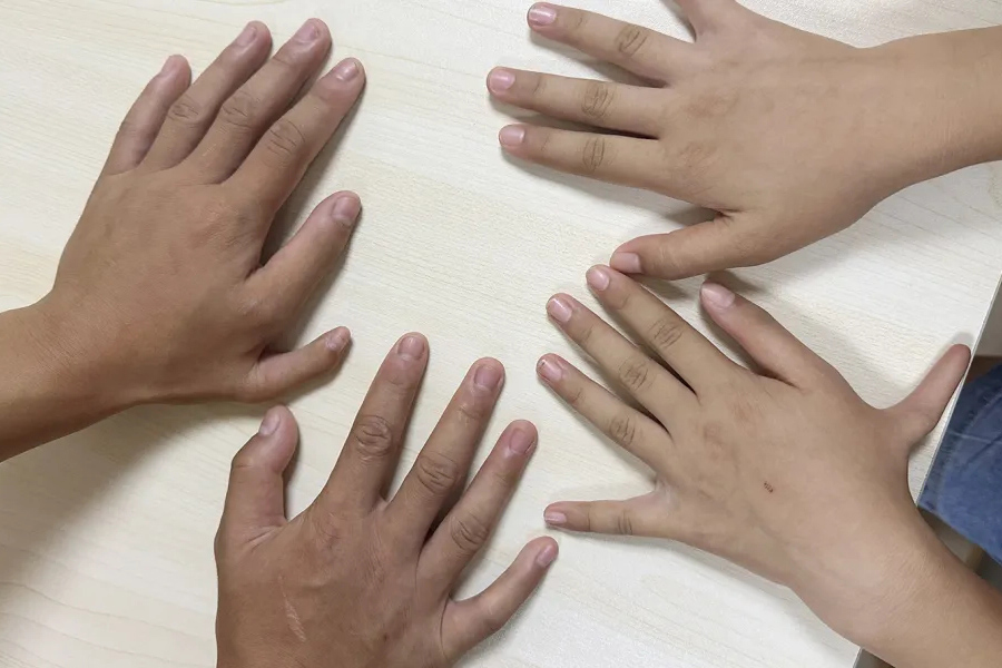 从自卑到绽放，六指兄妹“变形记”，桂林医护这波操作太戳心！